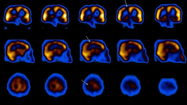 Med thumb narcolepsy brainwaves